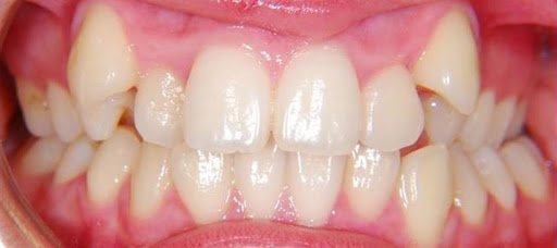 اصلاح دندان نیش بدون ارتودنسی