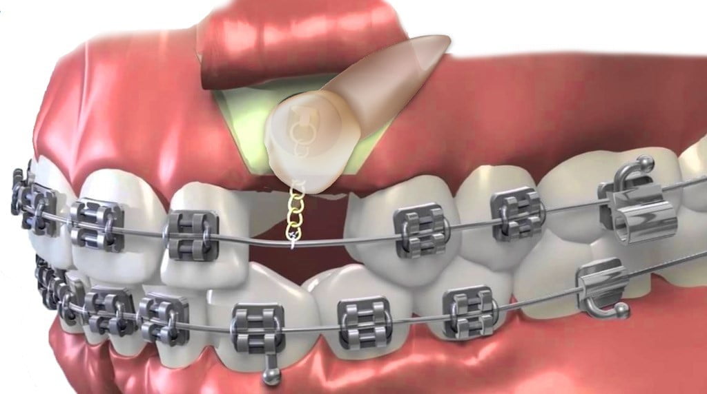 هزینه ارتودنسی دندان نیش