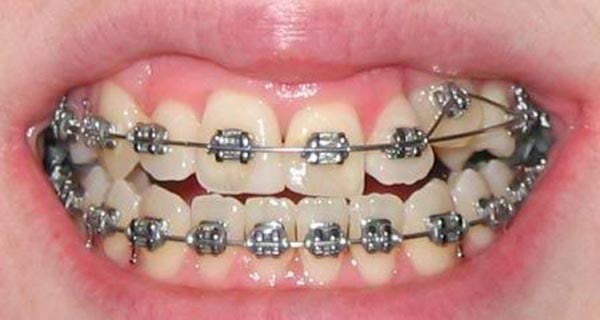 هزینه ارتودنسی دندان نیش بیرون زده