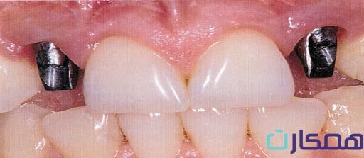 ایمپلنت دندان درد دارد؟ 