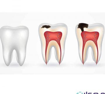 ترمیم سه سطحی دندان چیست
