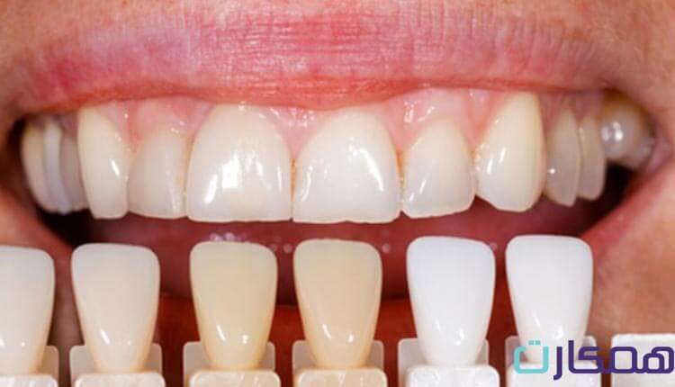 اصلاح تغییر رنگ کامپوزیت دندان
