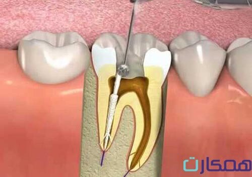 هزینه جراحی ریشه دندان